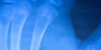 Global Axial Bone Densitometry Market Trending Research Report 2019 – BeamMed, CompuMed, CooperSurgical, Diagnostic Medical Systems – Market Research Time