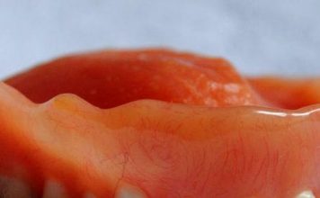 A man’s missing dentures were found stuck in his throat 8 days after surgery – Valley News Live